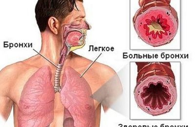 ХОБЛ страдают больше 15 тысяч жителей Новосибирской области