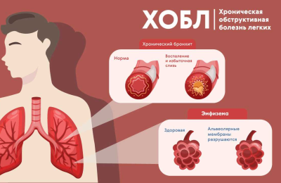 В Новосибирской области 16 тысяч больных ХОБЛ. У 90% причина болезни – курение