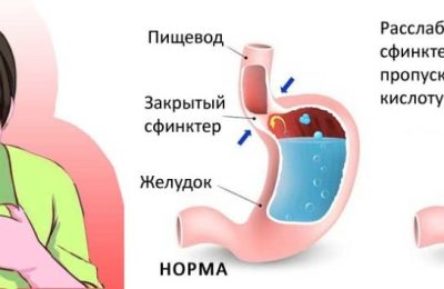 Отрыжка после еды — причины