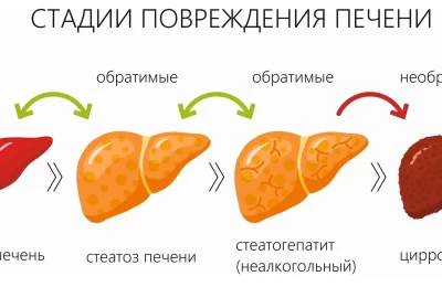 Цирроз печени — признаки