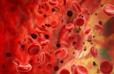 Скажем нет «плохому» холестерину